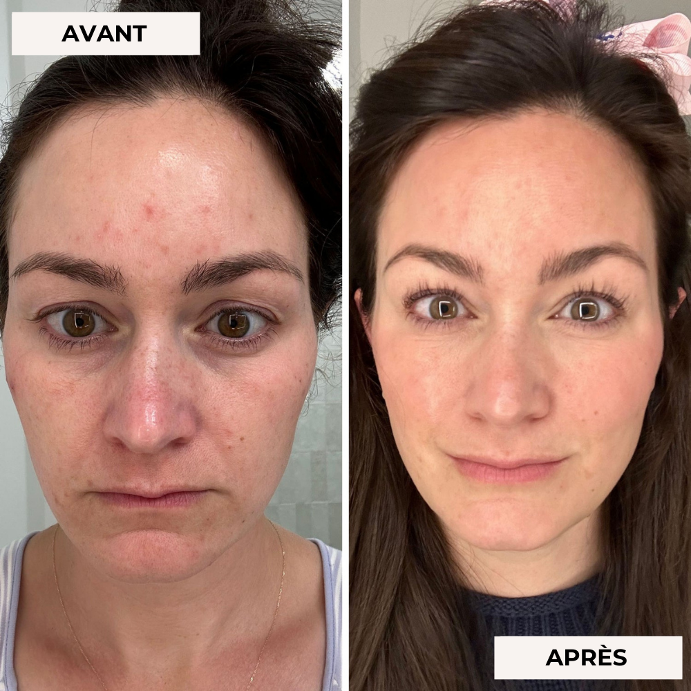 Masque facial de luminothérapie 2.0