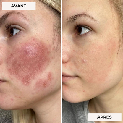 Masque facial de luminothérapie 2.0